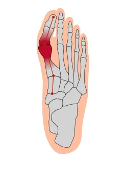 Outlet BADER Hallux valgus Soft Bandage SCHWARZ
